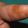 Brown Spots On Finger Tips