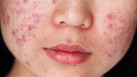 jerawat atau alergi produk perawatan wajah