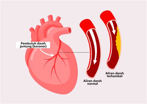 penyakit jantung perifer