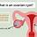 Ovarian-Cyst-Size-Chart
