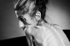 anorexia nervosa farrokh anoressica rachael willowdot21 crowdfunding disorders