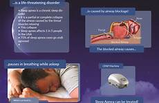 apnea snoring sleepiness suffering putting daytime