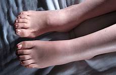 edema oedema swollen swelling ankles nhs bengkak kaki tungkai pergelangan concerned puffy sehat