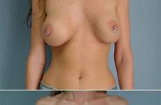 breast augmentation xnxx