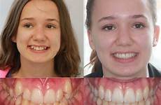 braces extraction orthodontics orthodontist halved
