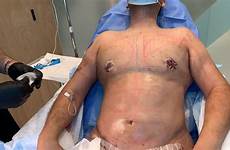 tummy tuck massage lymphatic liposuction gladiator