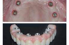 dentures implants denture