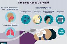 sleep apnea snoring remedies types guide treatment sleeping disorder quick its leave advertisement common