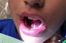 lingual palatal frenuloplasty suction technique