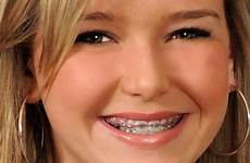 braces pink beautiful girl powerchain colors teenagers teenage young smile woman off blond showing