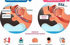 apnea obstructive osa breathing