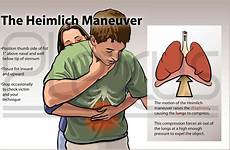 heimlich maneuver do choking perform abdominal thrusts learn yourself technique kalw emergency choked mine friend death person back plexus preparednessadvice