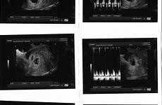ultrasound weeks triplet pregnancy week trio texas