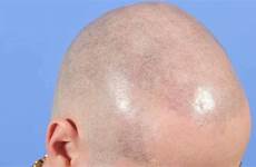 scalp hair micropigmentation head transplant shaved results bald loss degree technique applicable almost any