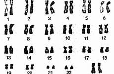 chromosomes female karyotype syndrome down human trisomy chromosome 21 male info normal dna sorted ds problem pairs person sex look