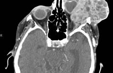 lacrimal gland cystic ct adenoid carcinoma maxillofacial imaging coronal orbital performed repeat left mass bone cases globe