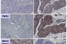 staining mmr pms2 immunohistochemical msh2 mlh1 msh6