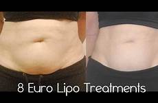 lipo laser after before
