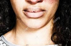 woman face bruised bruises badly stock young alamy her