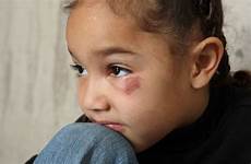 abuse neglect abused injured protection bruises bruised bruise harm victim responding reasons