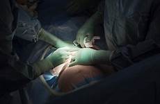 section cesarean report rising caesarean sections births procedure rate hospitals private who health alarming says raises concerns rates perform surgeons