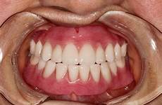 dentures mouth dental jacksonville fl