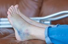 bruised bruise injuries bruises sprains metoda jaka urazy