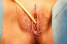 transexual vaginoplasty reassignment transsexualism