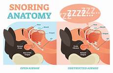 snoring snore tongue airway dentist