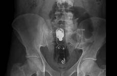 xray rectal xrays butt radiopaedia radiology rectum colon vibrator into misadventure