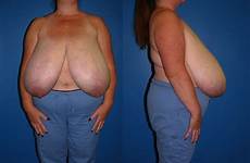 reduction saggy udders