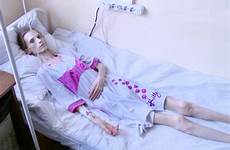 anorexic woman anorexia bed women dying real over just skeletal stone two chronic she