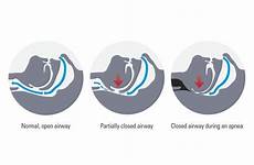 sleep apnea obstructive central between difference resmed osa csa