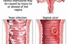 intercourse sex vaginal painful after vagina dryness causes dry sexual infection pain during women area skin do dyspareunia occur medical