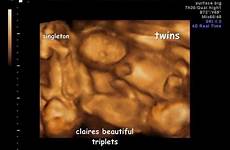 triplets ultrasound womb