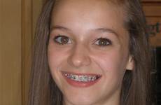 braces girls face brace cute colors two her