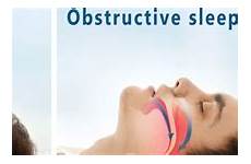 sleep apnea obstructive osa symptoms normal illustration airway