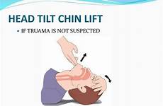 chin tilt airway suspected truama