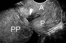 placenta previa transvaginal sonogram posterior partial cervix covering
