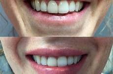 before after smile lip flip lips juvederm bottom vollure top botox injections save gone
