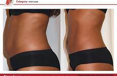lipo laser before after non invasive loss body treatment liposuction inch strawberry sculpting results choose board contouring