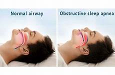 apnea obstructive