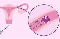 process insemination iui artificial intrauterine invitra step
