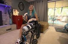 leg shark attack victim winter paige her lost left teen after losing healing opens fingers amputated two morning america good