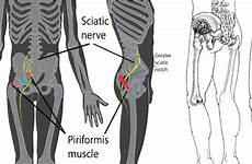 piriformis pain syndrome radiates hip leg numbness sitting sciatica while legs down back muscle spine spasms joint livelovefruit heal causes