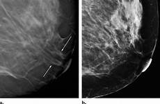 ducts lactiferous mammography