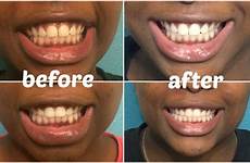 charcoal activated whitening whiten does dental bleaching diethics whiter benefit deeply