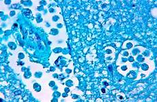 amoeba naegleria fowleri infected child abcnews