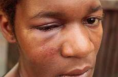 cheekbone swelling bruising person bruises after cuts ethnic woman broken fractured great show beaten skin dark collier suffered sharon attack