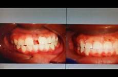 gap braces before after closing adult diastema results